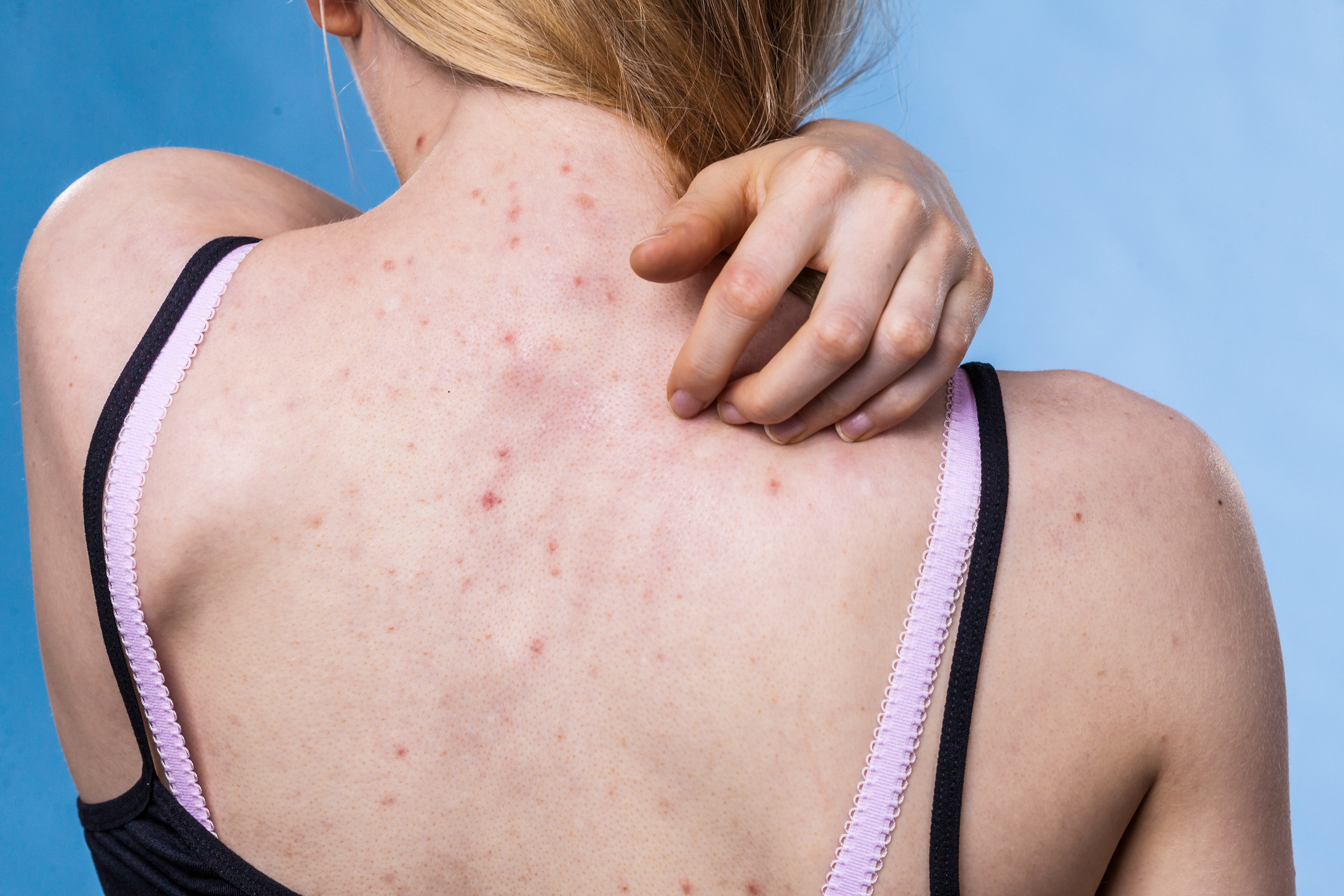 back acne scarring
