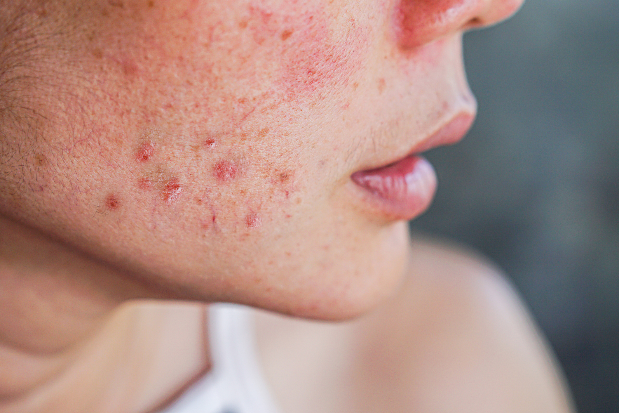 facial acne scarring