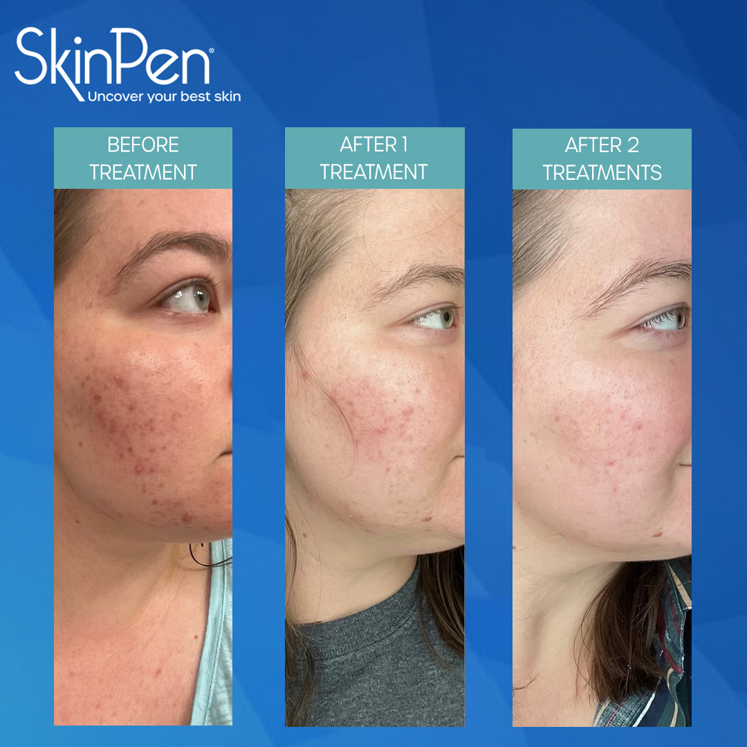 Microneedle before and after
