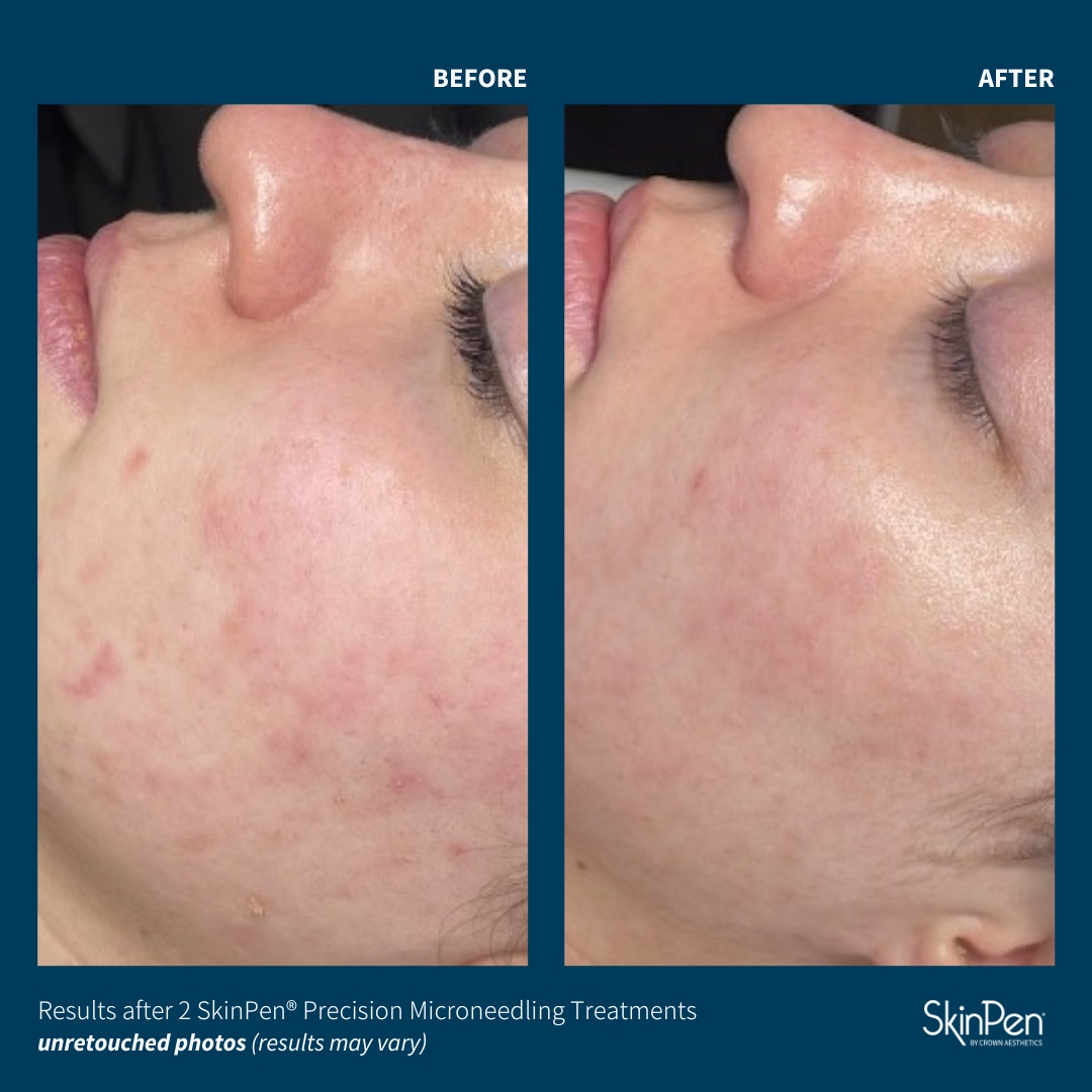 Microneedle before and after
