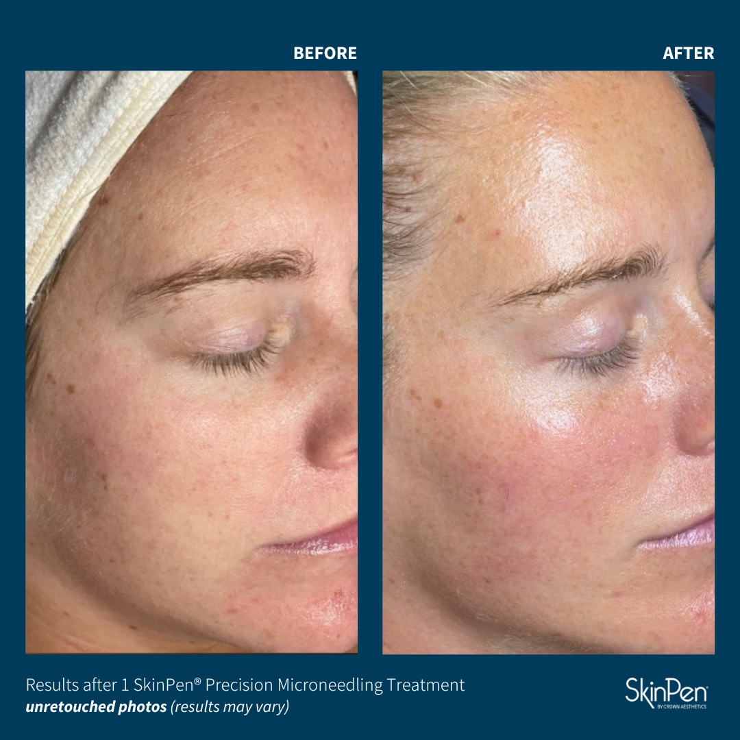 Microneedle before and after