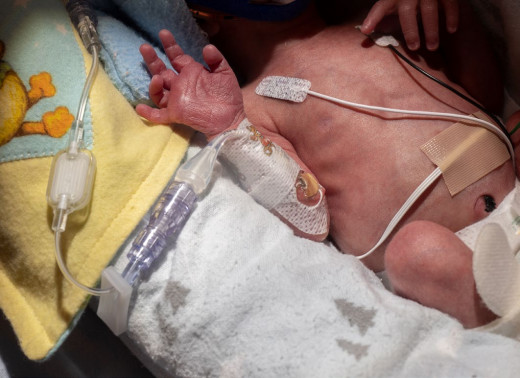 A PICC line in an infant in the NICU