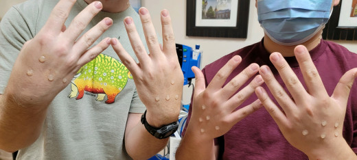monkeypox moulage