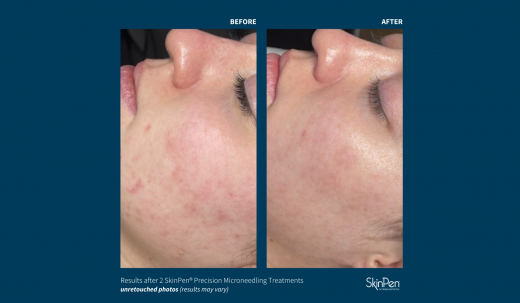 before and after images of SkinPen microneedling treatment 