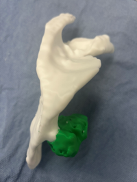 Side view of 3D printed model showing scapula and osteochondroma