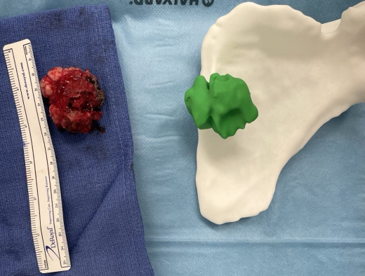 Picture of excised tumor beside of the 3D printed anatomical model