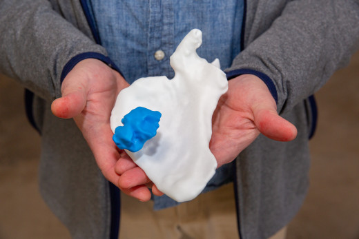 Hands holding a 3D printed model of osteochondroma on the left anterior scapula