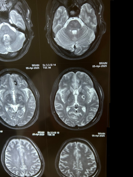 Post-operative MRI of patient after a left-sided radiofrequency pallidotomy performed to control the symptoms of Parkinson’s Disease