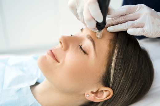 microneedling procedure